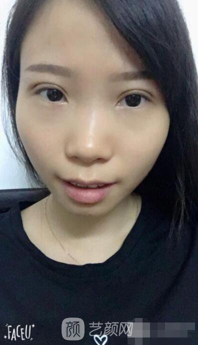 莊璐全切雙眼皮照 全過程恢復(fù)經(jīng)驗之談