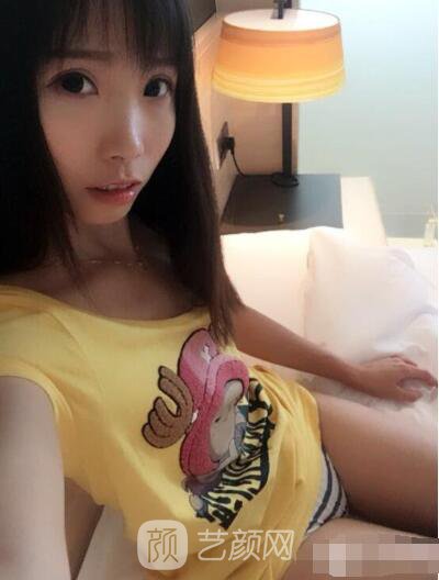 莊璐全切雙眼皮照 全過程恢復(fù)經(jīng)驗之談