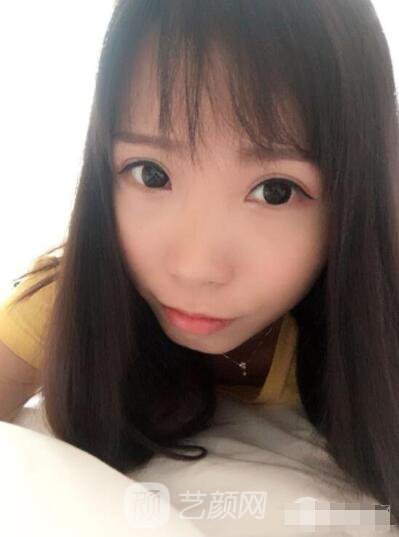 莊璐全切雙眼皮照 全過程恢復(fù)經(jīng)驗之談