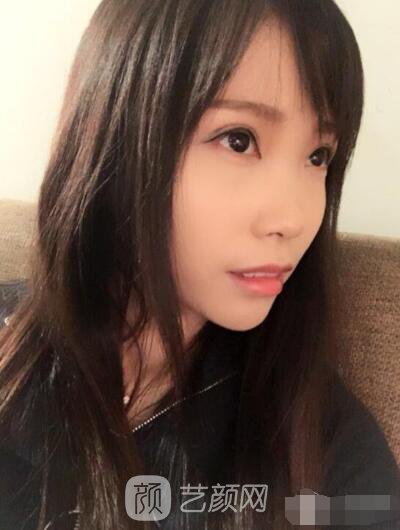 莊璐全切雙眼皮照 全過程恢復(fù)經(jīng)驗之談