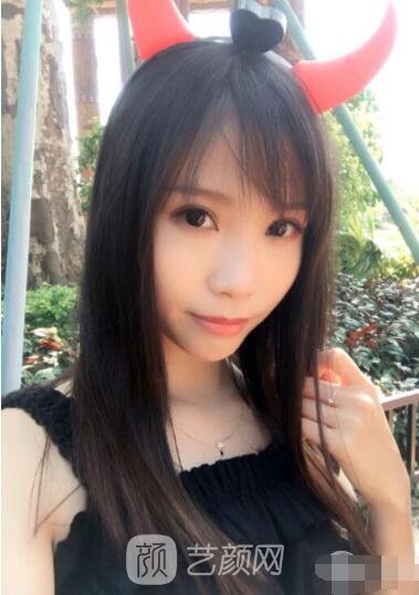 莊璐全切雙眼皮照 全過程恢復(fù)經(jīng)驗之談