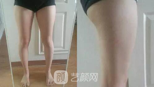 東莞締美陳星光大腿吸脂照片 內(nèi)附全部恢復(fù)過程體驗(yàn)