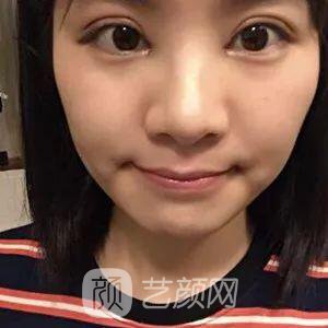 西安碑林西美王艷娜雙眼皮圖 真實(shí)案例心情分享
