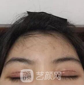 西安碑林西美王艷娜雙眼皮圖 真實(shí)案例心情分享