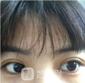 西安碑林西美王艷娜雙眼皮圖 真實(shí)案例心情分享