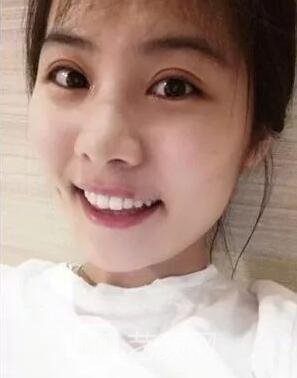 西安碑林西美王艷娜雙眼皮圖 真實(shí)案例心情分享