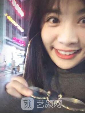 西安碑林西美王艷娜雙眼皮圖 真實(shí)案例心情分享