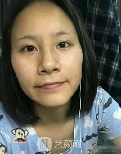 北京上上相鄭楚蓉院長自體脂肪填充全臉圖心情小記