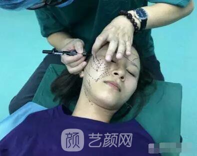 北京上上相鄭楚蓉院長自體脂肪填充全臉圖心情小記