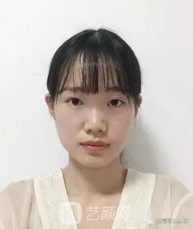 王紅敏切開雙眼皮+開內(nèi)眼角圖術(shù)后心情小述