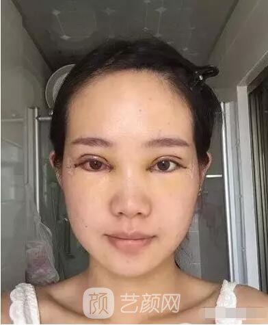 王紅敏切開雙眼皮+開內(nèi)眼角圖術(shù)后心情小述