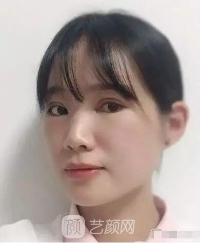 王紅敏切開雙眼皮+開內(nèi)眼角圖術(shù)后心情小述