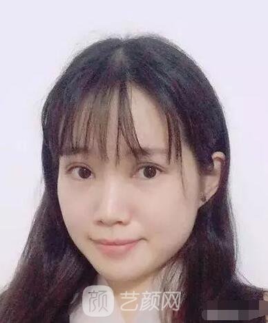 王紅敏切開雙眼皮+開內(nèi)眼角圖術(shù)后心情小述