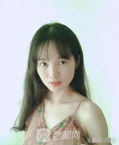 王紅敏切開雙眼皮+開內(nèi)眼角圖術(shù)后心情小述