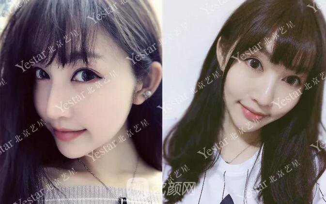 北京藝星整形醫(yī)院注射瘦臉￥499 | 打完半個(gè)月，來看看果!