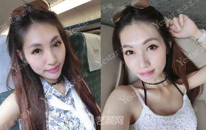 北京藝星整形醫(yī)院注射瘦臉￥499 | 打完半個(gè)月，來看看果!