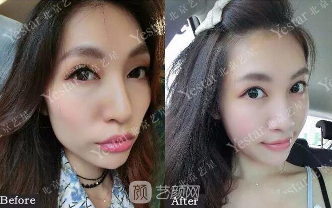 北京藝星整形醫(yī)院注射瘦臉￥499 | 打完半個(gè)月，來看看果!