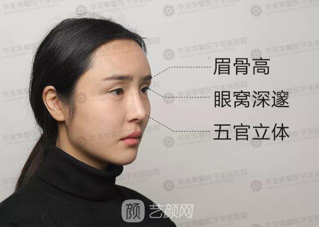 華美紫馨雙眼皮失敗修復(fù)圖純分享案例