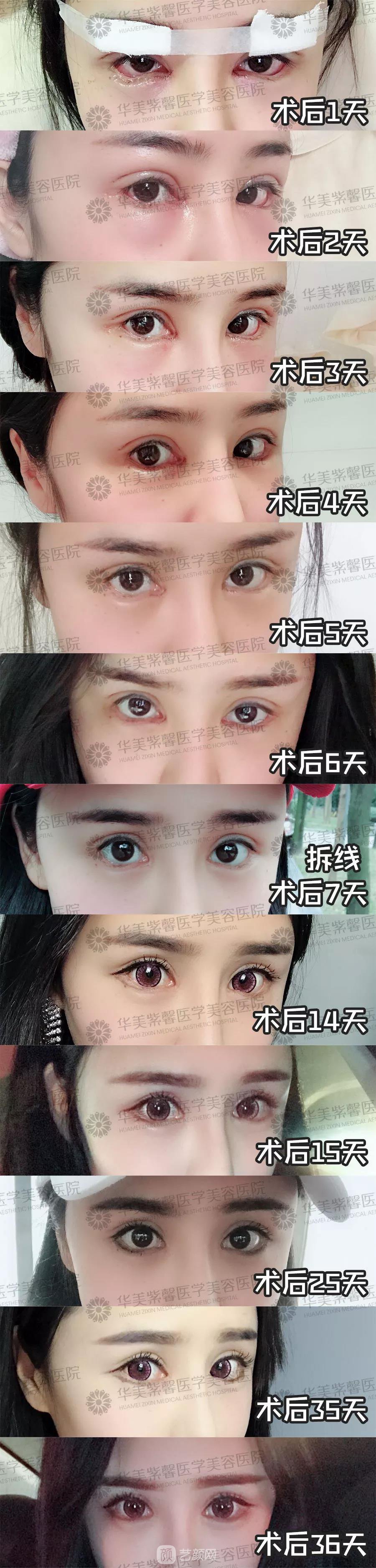 華美紫馨雙眼皮失敗修復(fù)圖純分享案例