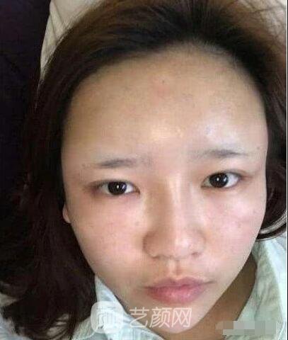 艾紅梅面部自體脂肪填充手術圖心情分享