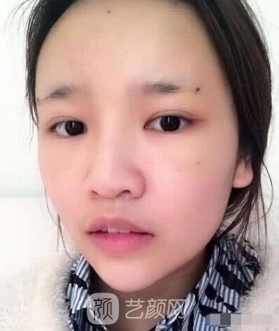 艾紅梅面部自體脂肪填充手術圖心情分享