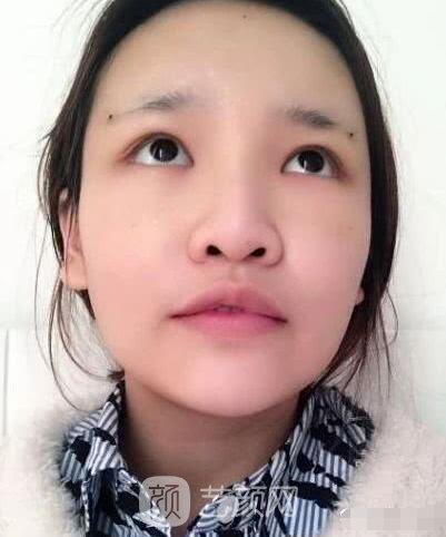 艾紅梅面部自體脂肪填充手術圖心情分享