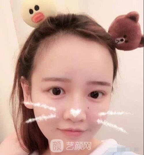 艾紅梅面部自體脂肪填充手術圖心情分享