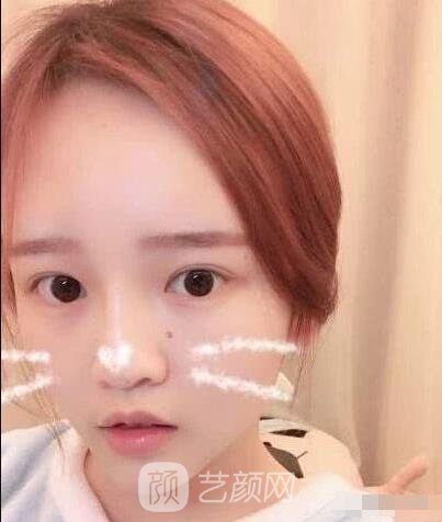 艾紅梅面部自體脂肪填充手術圖心情分享