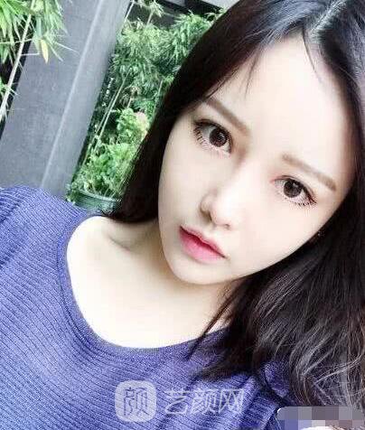 艾紅梅面部自體脂肪填充手術圖心情分享