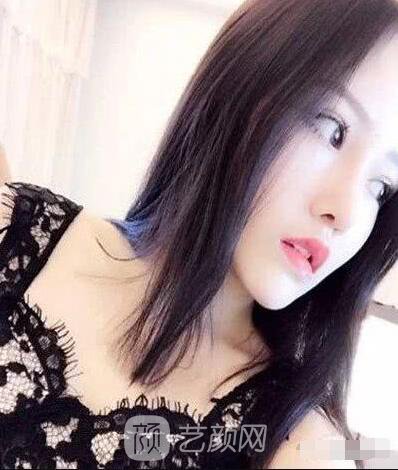 艾紅梅面部自體脂肪填充手術圖心情分享