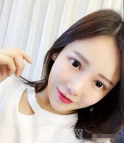 艾紅梅面部自體脂肪填充手術圖心情分享