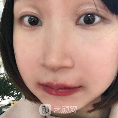 中日友好醫(yī)院高占巍磨下頜角案例分享~