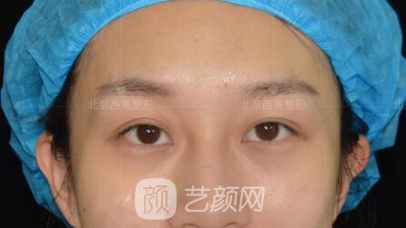 北京西美整形全切雙眼皮，徹底拯救我的大小眼