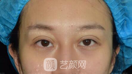 北京西美整形全切雙眼皮，徹底拯救我的大小眼