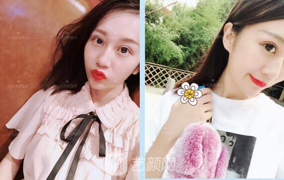 北京西美整形全切雙眼皮，徹底拯救我的大小眼