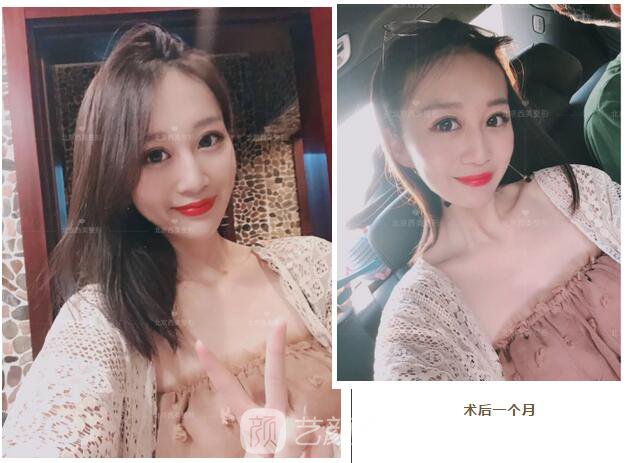 北京西美整形全切雙眼皮，徹底拯救我的大小眼