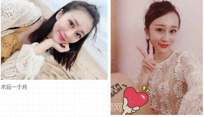 北京西美整形全切雙眼皮，徹底拯救我的大小眼