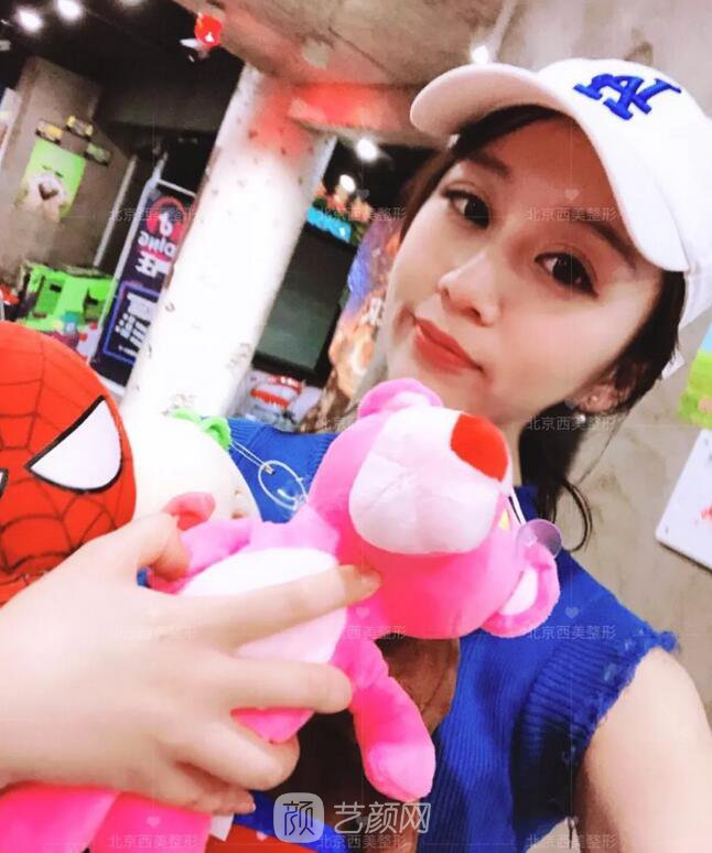北京西美整形全切雙眼皮，徹底拯救我的大小眼