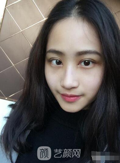 萍鄉(xiāng)優(yōu)美整形李清芳全切雙眼皮照片 拯救眼睛不對稱