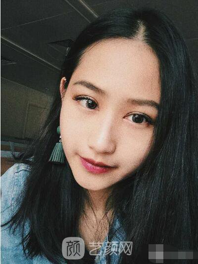 萍鄉(xiāng)優(yōu)美整形李清芳全切雙眼皮照片 拯救眼睛不對稱