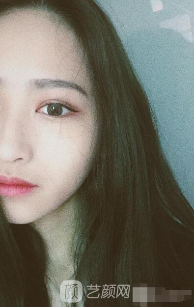 萍鄉(xiāng)優(yōu)美整形李清芳全切雙眼皮照片 拯救眼睛不對稱