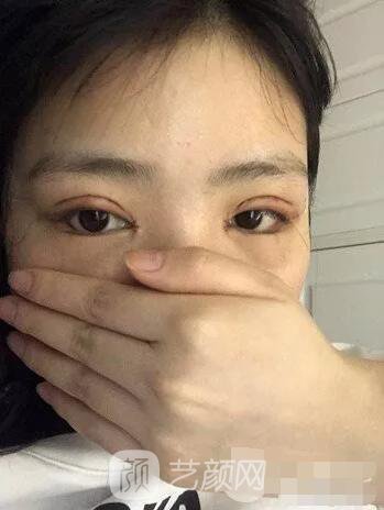 上海伊美爾港華醫(yī)院開雙眼皮圖 大小眼的救星