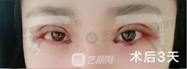 成都華美紫馨平行雙眼皮真人案例反饋照片