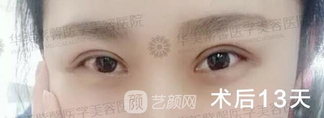 成都華美紫馨平行雙眼皮真人案例反饋照片
