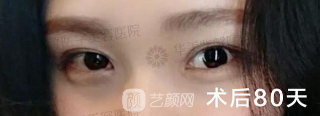 成都華美紫馨平行雙眼皮真人案例反饋照片