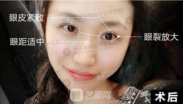 成都華美紫馨平行雙眼皮真人案例反饋照片