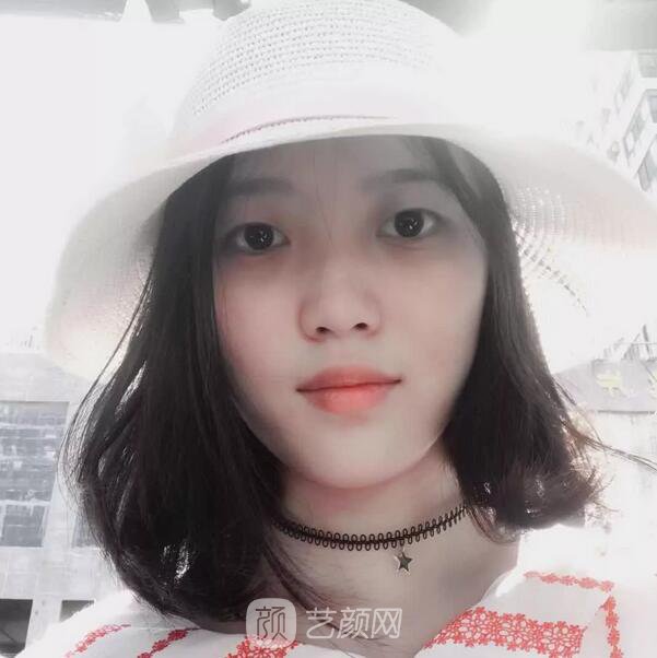 北京西美整形醫(yī)院全切雙眼皮真人案例圖|內(nèi)附恢復(fù)過程哦~