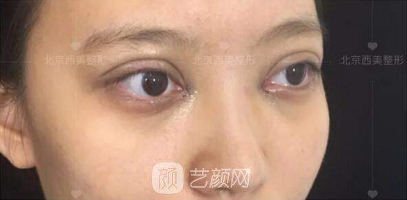 北京西美整形醫(yī)院全切雙眼皮真人案例圖|內(nèi)附恢復(fù)過程哦~