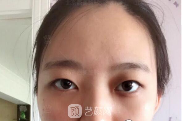 北京西美整形醫(yī)院全切雙眼皮真人案例圖|內(nèi)附恢復(fù)過程哦~