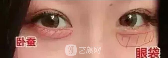 北京藝星整形Yestar分齡祛眼袋真實案例圖分享哦~